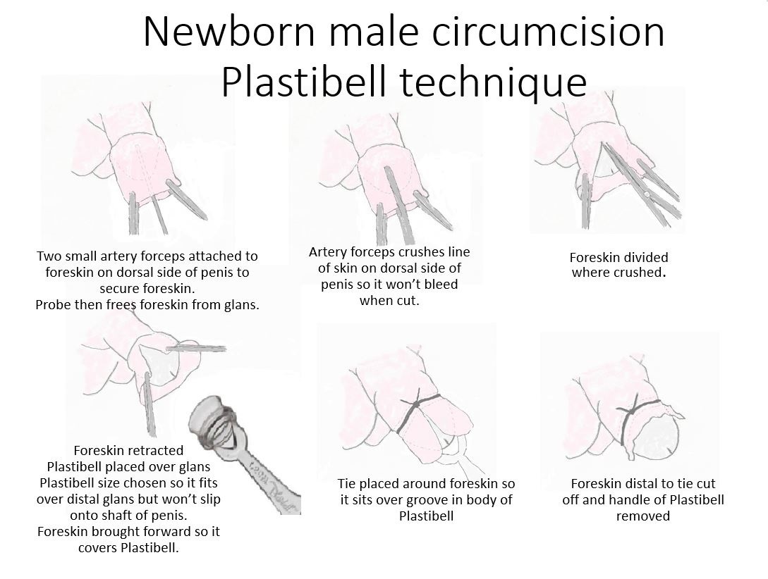 Plastibell circumcision technique diagram